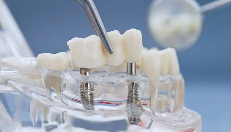How Do Implants and Bridges Compare for One Missing Tooth