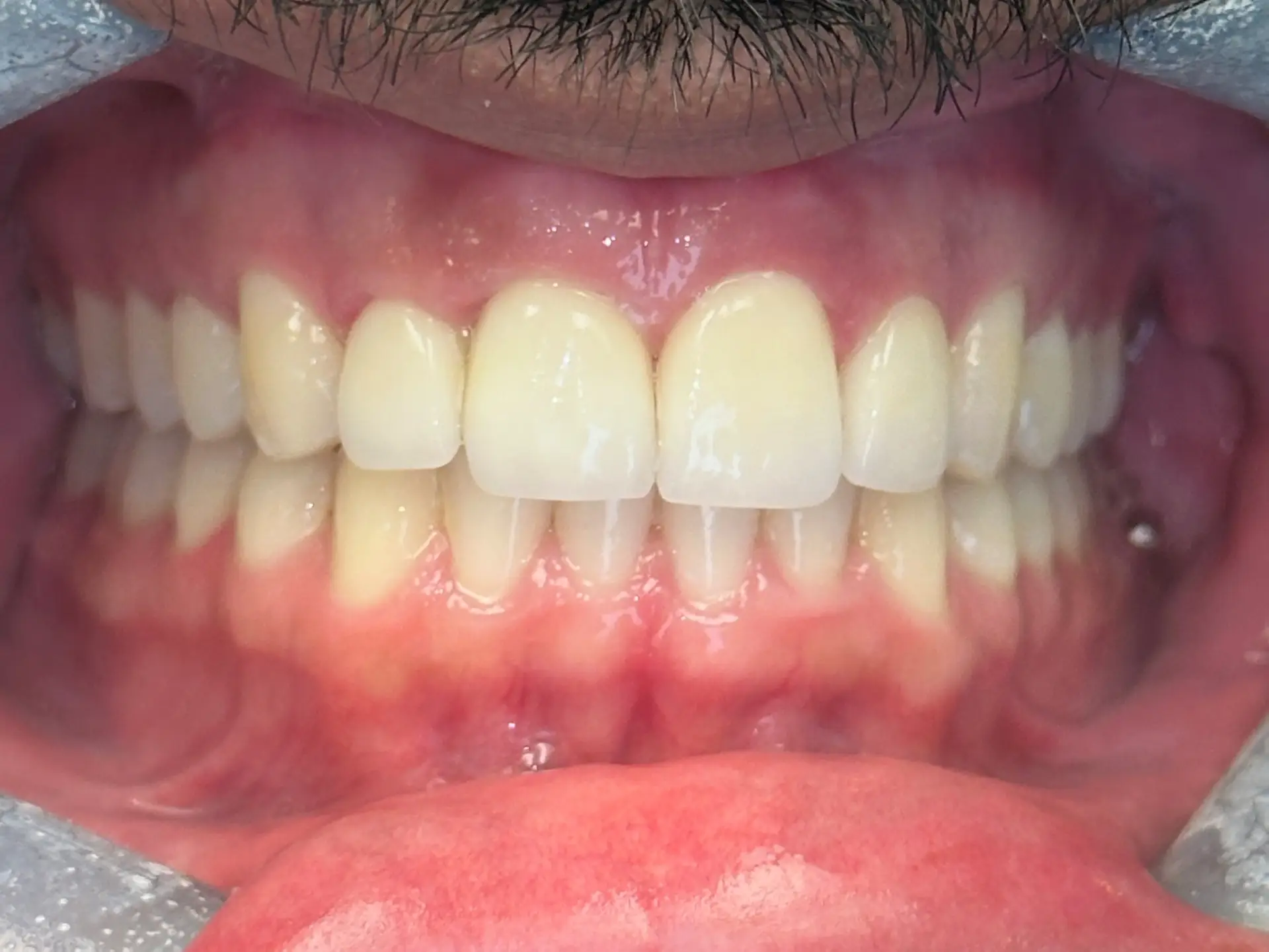 Healthy, straight teeth with bright smile.