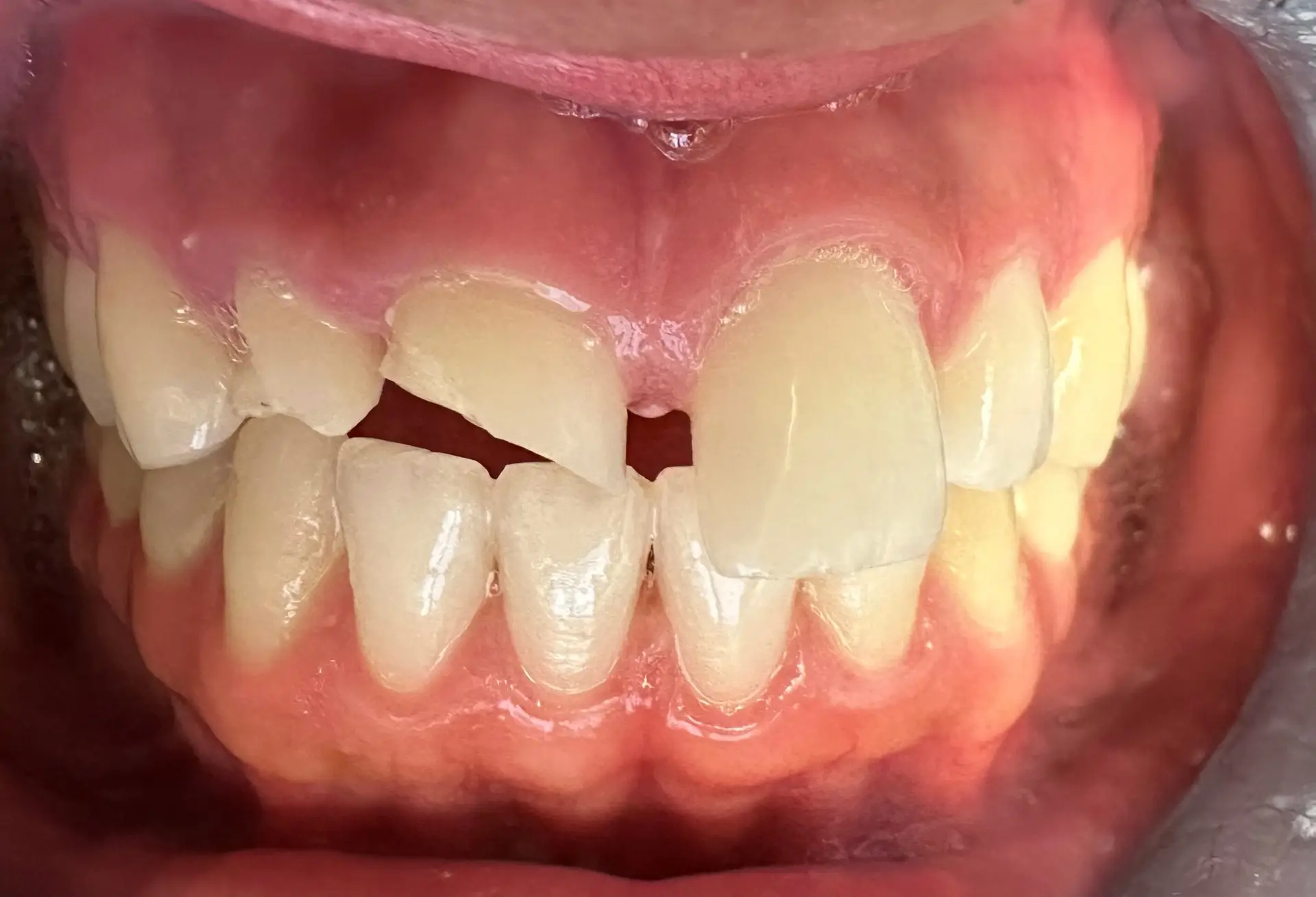 Invis & Root Canals & Crowns_Veneers Before