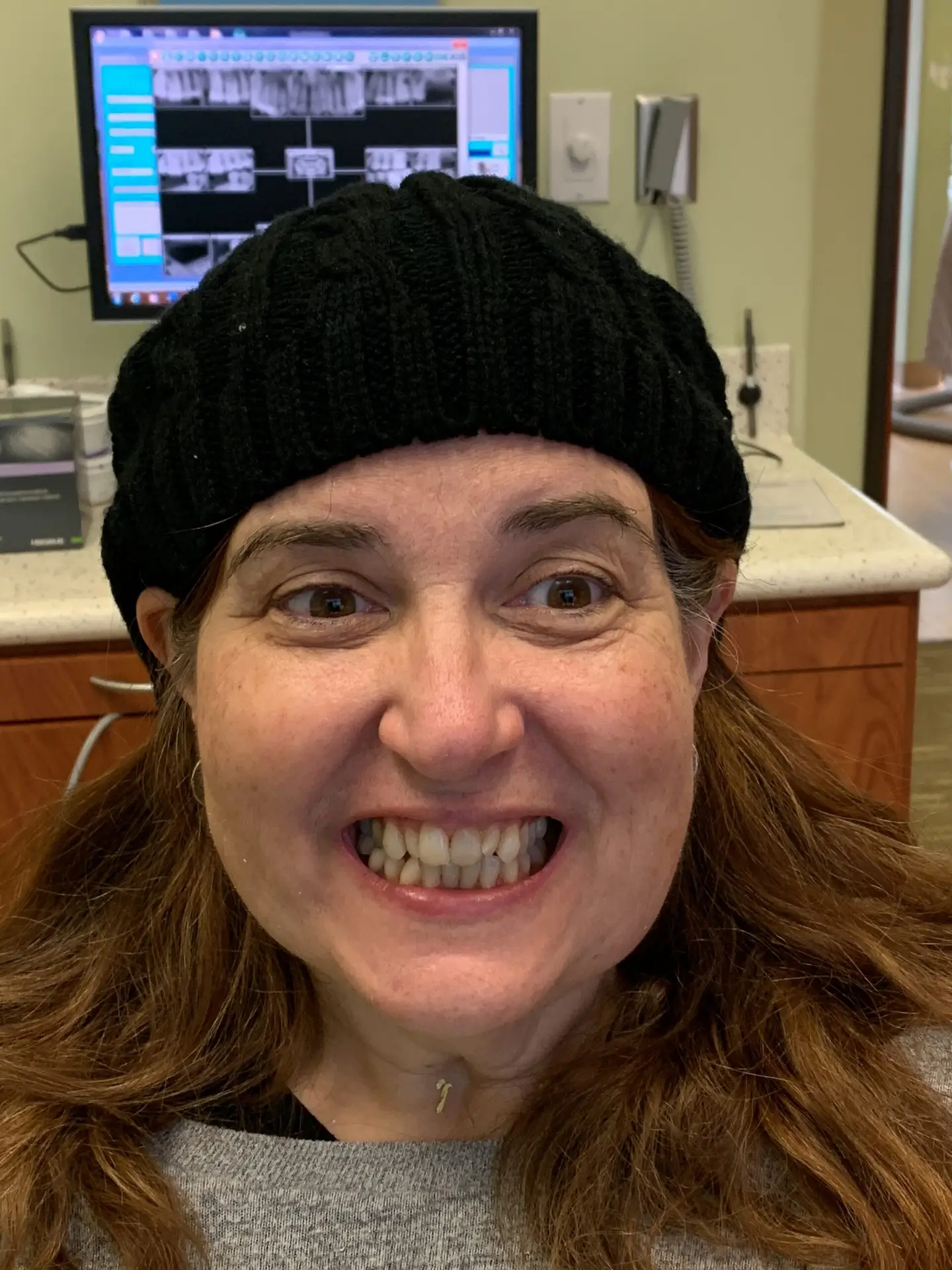 Invisalign 1 Before