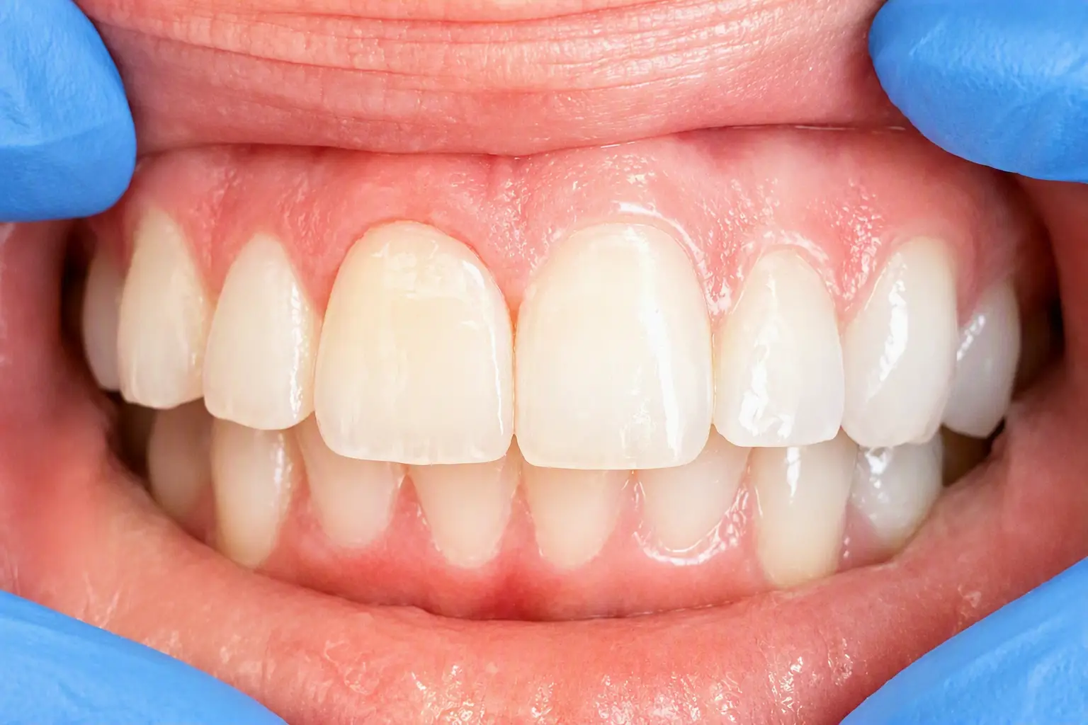Veneers 1 After