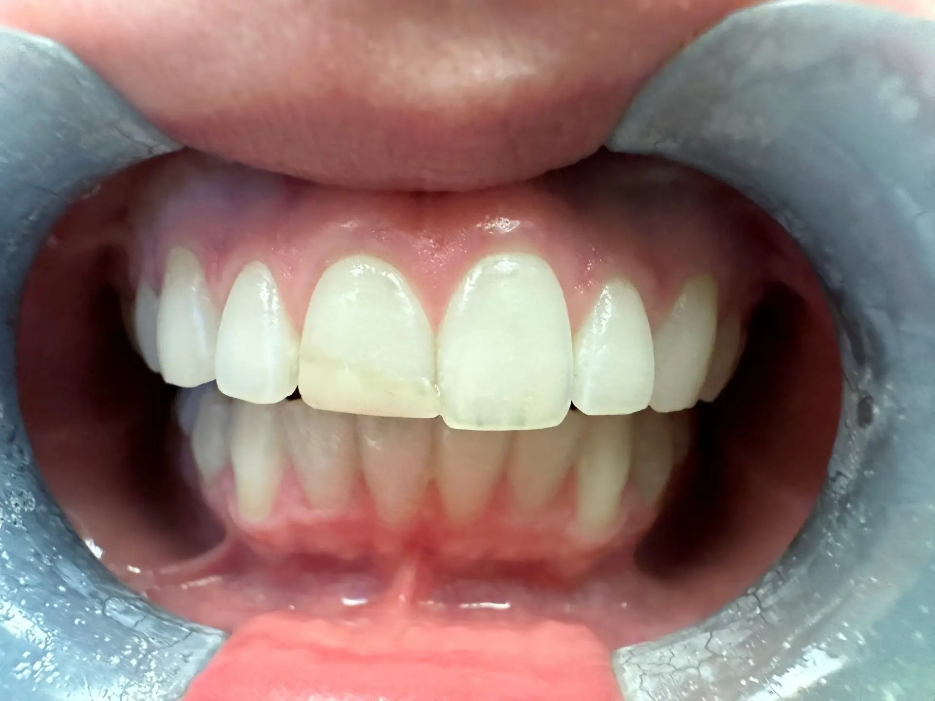 Veneers 1 Before