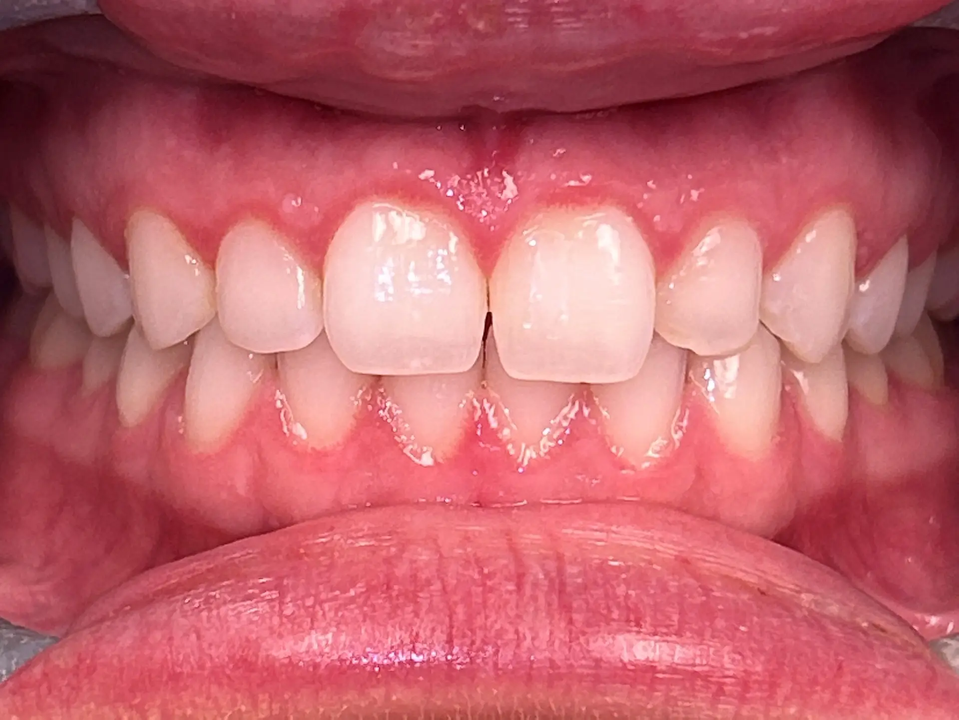 Veneers 3 Before