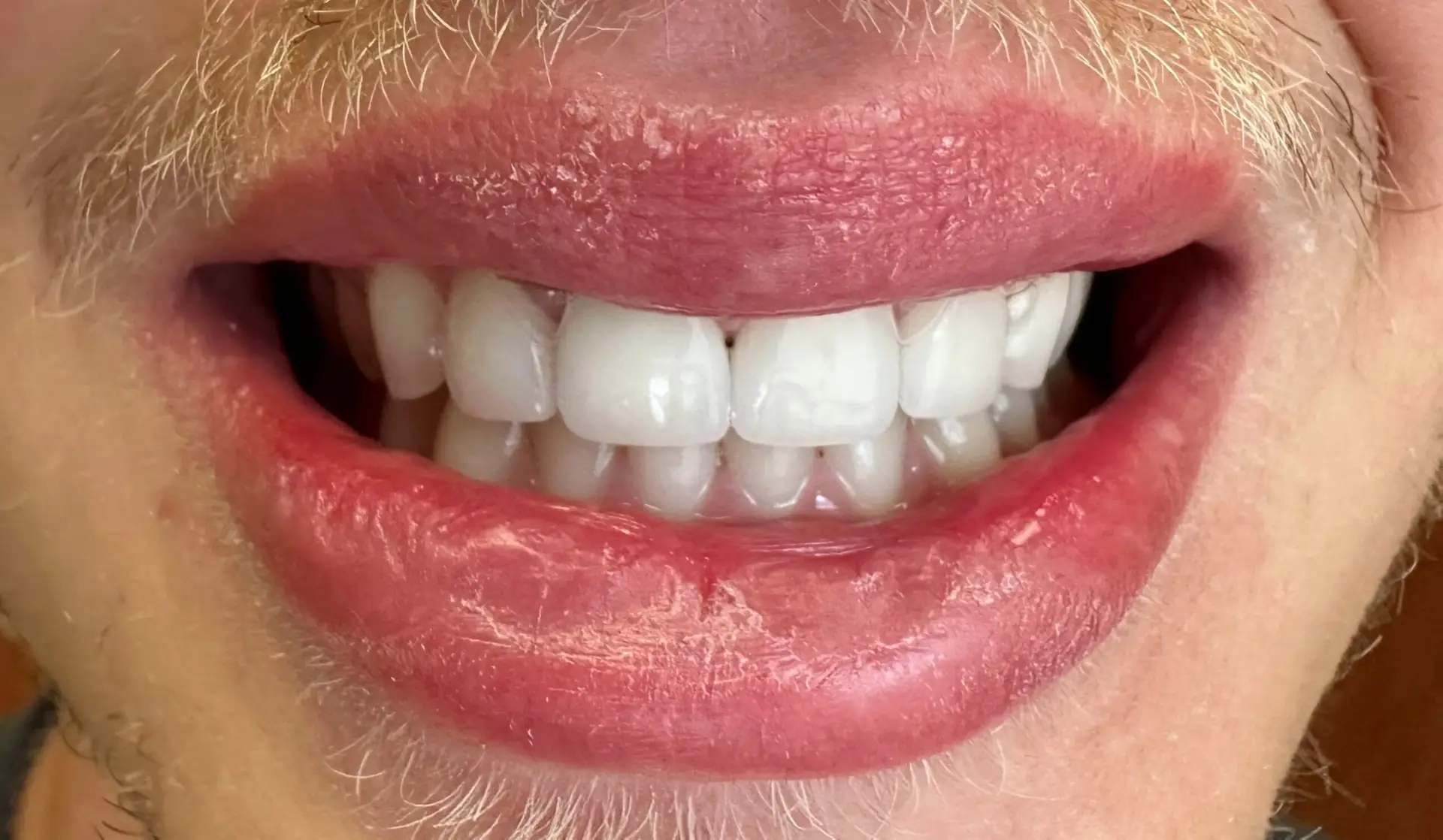 Veneers 4 After
