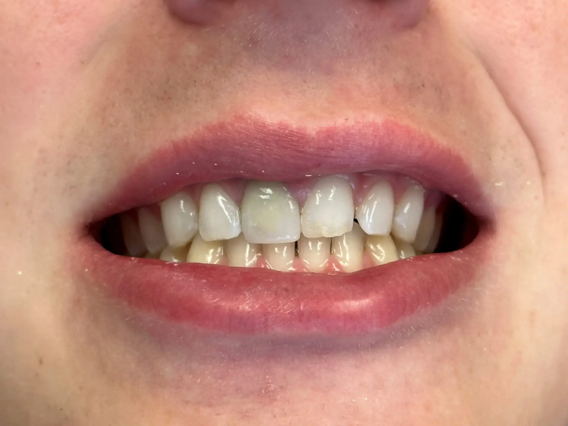 Veneers 4 Before