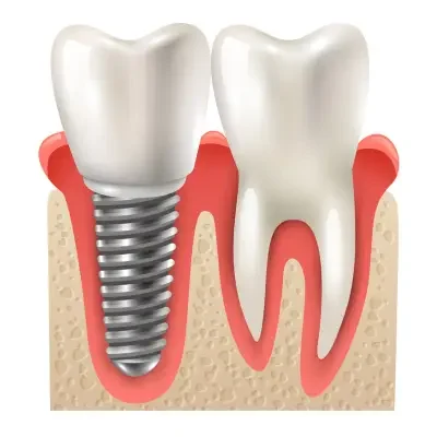 an animated image of what a single tooth dental implant looks like.
